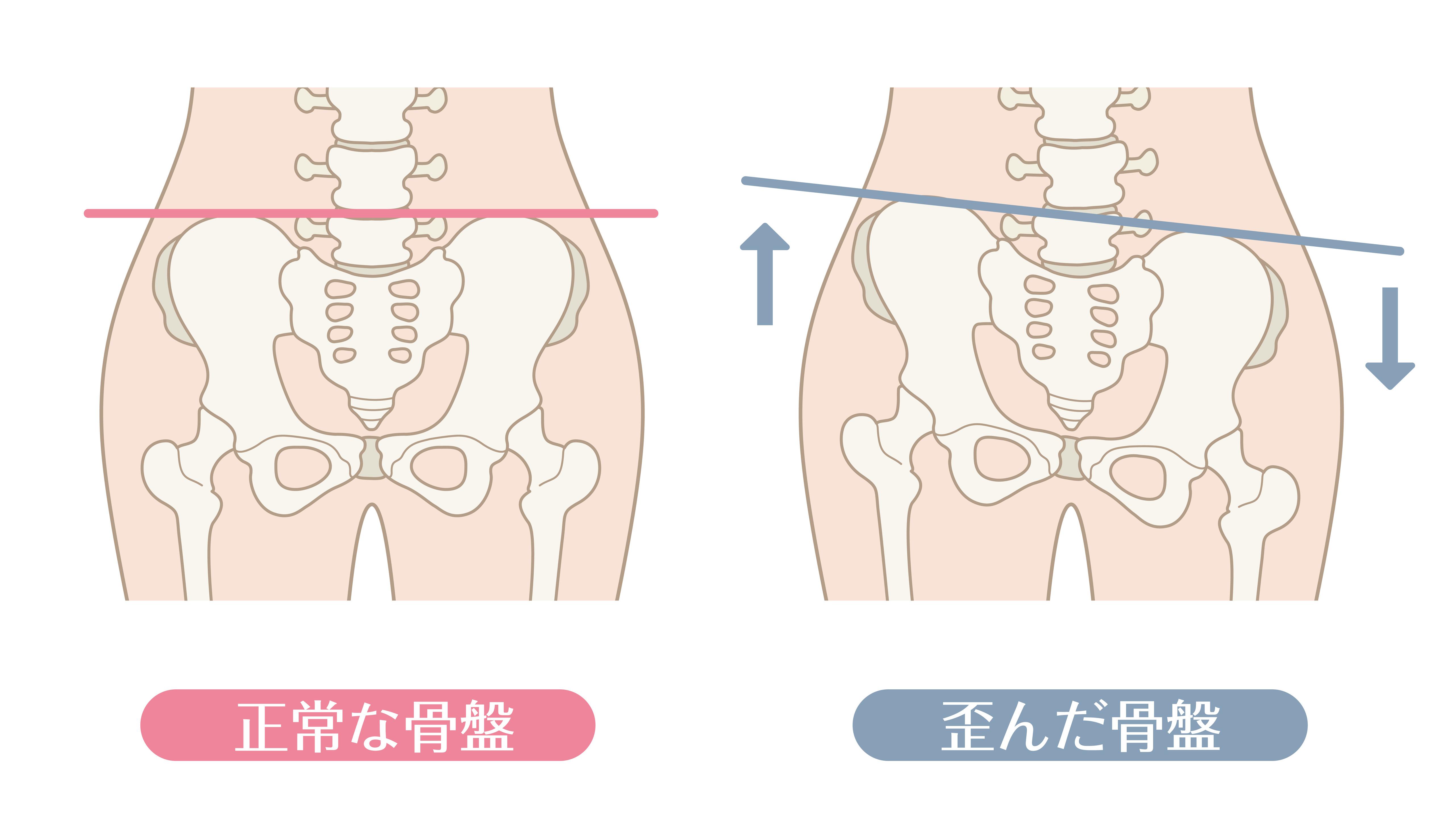 正しい骨盤の位置と、歪んだ骨盤の位置